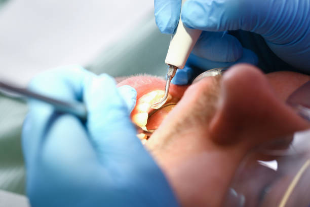 Best Emergency Root Canal Treatment in Drum Point, MD