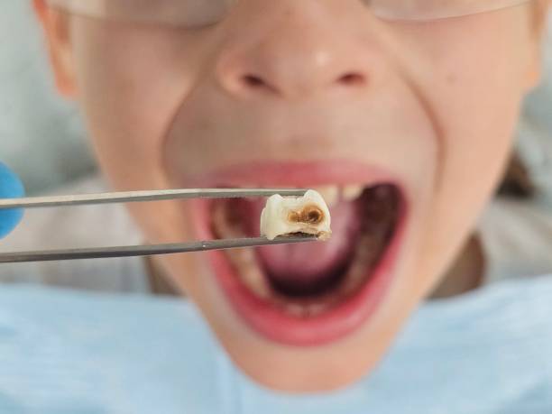 Best Emergency Dentist for Lost Fillings or Crowns in Drum Point, MD