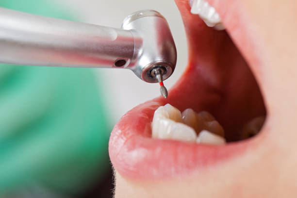 Best Emergency Dental Extractions in Drum Point, MD